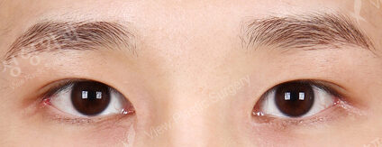 Fat Graft+Magic Epicanthoplasty+Lateral Canthoplasty (1 Months ) — After