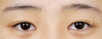 Lateral Canthoplasty+Lower Canthoplasty (1 Months ) — Before