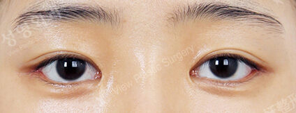 Lateral Canthoplasty+Lower Canthoplasty (1 Months ) — After