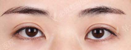 Combination Ptosis Correction Surgery (6 Months) — Before