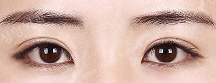 Combination Ptosis Correction Surgery (6 Months) — After