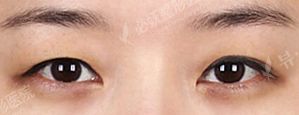 Combination Ptosis Correction Surgery+Sub-Brow Lift (5 Months) — Before