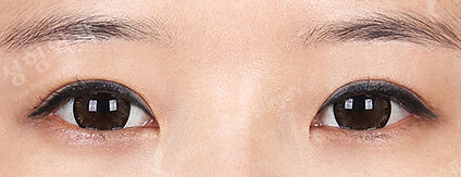 Combination Ptosis Correction Surgery+Sub-Brow Lift (5 Months) — After