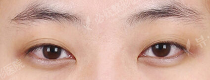 Incisional Ptosis Correction (1 Months ) — Before