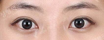 Incisional Ptosis Correction (1 Months ) — After