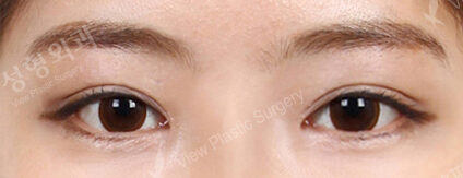 Fat Graft+Magic Epicanthoplasty (2 Months ) — After