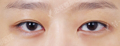 Combination Ptosis Correction Surgery (8 Months ) — Before