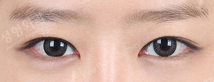 Combination Ptosis Correction Surgery (8 Months ) — After