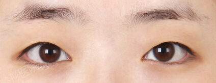 Combination Ptosis Correction Surgery (6 Months) — Before