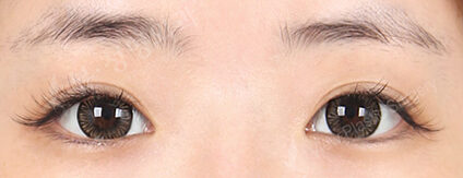 Combination Ptosis Correction Surgery (6 Months) — After