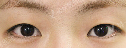 Fat Graft+Magic Epicanthoplasty (7 Months ) — Before