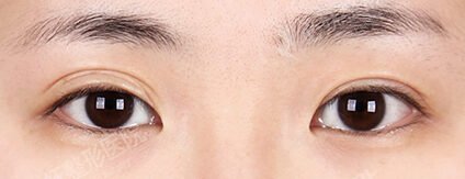 Double Eyelid (Revisional Surgery)+ Ptosis Correction+Lateral Canthoplasty+Lower Canthoplasty (3 Months) — Before