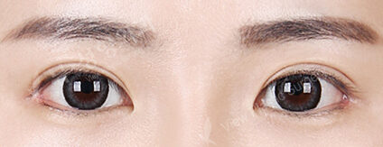 Double Eyelid (Revisional Surgery)+ Ptosis Correction+Lateral Canthoplasty+Lower Canthoplasty (3 Months) — After