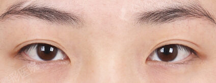 Combination Ptosis Correction Surgery+Epicanthoplasty+Transconjuntival fat removal (15 Months) — Before