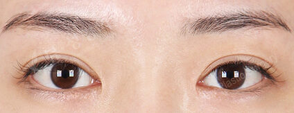 Combination Ptosis Correction Surgery+Epicanthoplasty+Transconjuntival fat removal (15 Months) — After