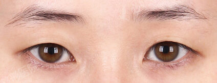 Combination Ptosis Correction Surgery+Lateral Canthoplasty+Lower Canthoplasty (9 Months) — Before