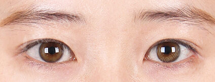 Combination Ptosis Correction Surgery+Lateral Canthoplasty+Lower Canthoplasty (9 Months) — After