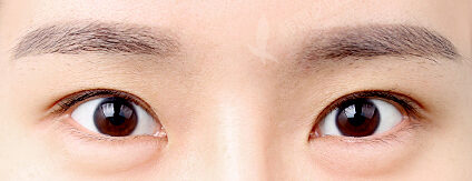 Revisional Eye Surgery+Lower Canthoplasty (5 Months) — Before