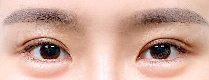 Revisional Eye Surgery+Lower Canthoplasty (5 Months) — After