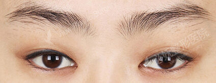 Fat Graft+Lateral Canthoplasty+Lower Canthoplasty (2 Months) — Before