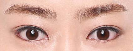Fat Graft+Lateral Canthoplasty+Lower Canthoplasty (2 Months) — After