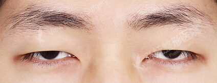 Combination Ptosis Correction Surgery (2 Months) — Before