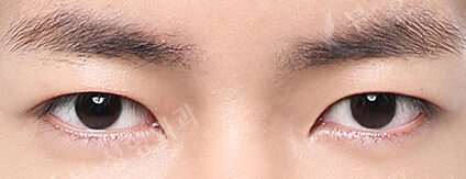 Combination Ptosis Correction Surgery (2 Months) — After