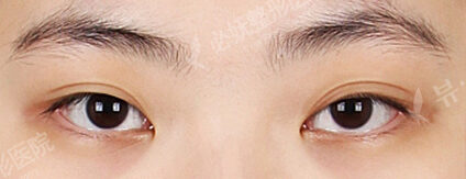 Combination Ptosis Correction Surgery+Epicanthoplasty (4 Months) — Before