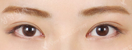 Combination Ptosis Correction Surgery+Epicanthoplasty (4 Months) — After
