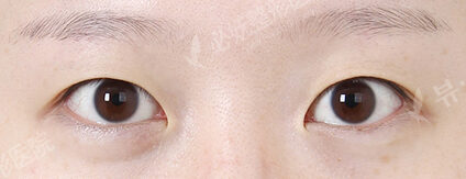 Combination Ptosis Correction Surgery (7 Months ) — Before