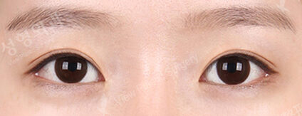 Combination Ptosis Correction Surgery (7 Months ) — After