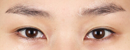 Revisional Eye Surgery (3 Months) — Before