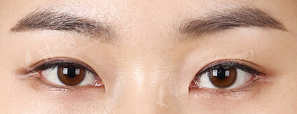 Revisional Eye Surgery (3 Months) — After