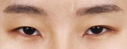 Combination Ptosis Correction Surgery+Epicanthoplasty+Lateral Canthoplasty+Lower Canthoplasty (9 Months) — Before