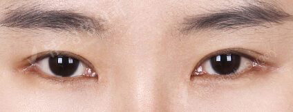 Combination Ptosis Correction Surgery+Epicanthoplasty+Lateral Canthoplasty+Lower Canthoplasty (9 Months) — After