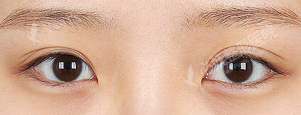 Combination Ptosis Correction Surgery + Epicanthoplasty(4 Months) — Before