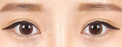 Combination Ptosis Correction Surgery + Epicanthoplasty(4 Months) — After