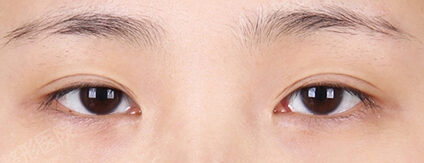 Lateral Canthoplasty+Lower Canthoplasty (3 Months) — Before