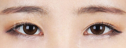 Lateral Canthoplasty+Lower Canthoplasty (3 Months) — After