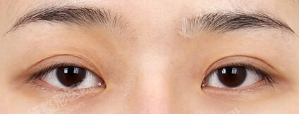 Combination Ptosis Correction Surgery (9 Months) — Before