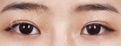 Combination Ptosis Correction Surgery (9 Months) — After