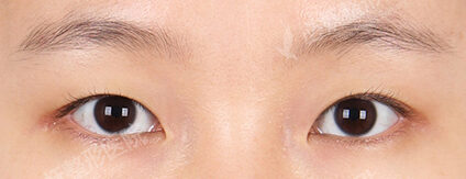 Combination Ptosis Correction Surgery+Epicanthoplasty (3 Months) — Before