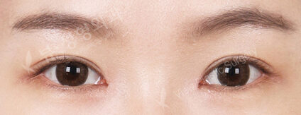 Combination Ptosis Correction Surgery+Epicanthoplasty (3 Months) — After