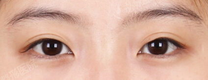Combination Ptosis Correction Surgery (7 Months) — Before