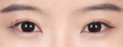 Combination Ptosis Correction Surgery (7 Months) — After