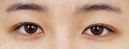 Revisional Eye Surgery (15 Months) — Before