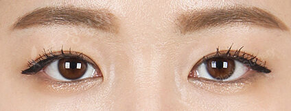 Revisional Eye Surgery (15 Months) — After