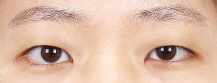 Combination Ptosis Correction Surgery+Epicanthoplasty (5 Months) — Before