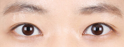 Combination Ptosis Correction Surgery+Epicanthoplasty (5 Months) — After