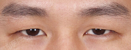 Combination Ptosis Correction Surgery (3 Months) — Before